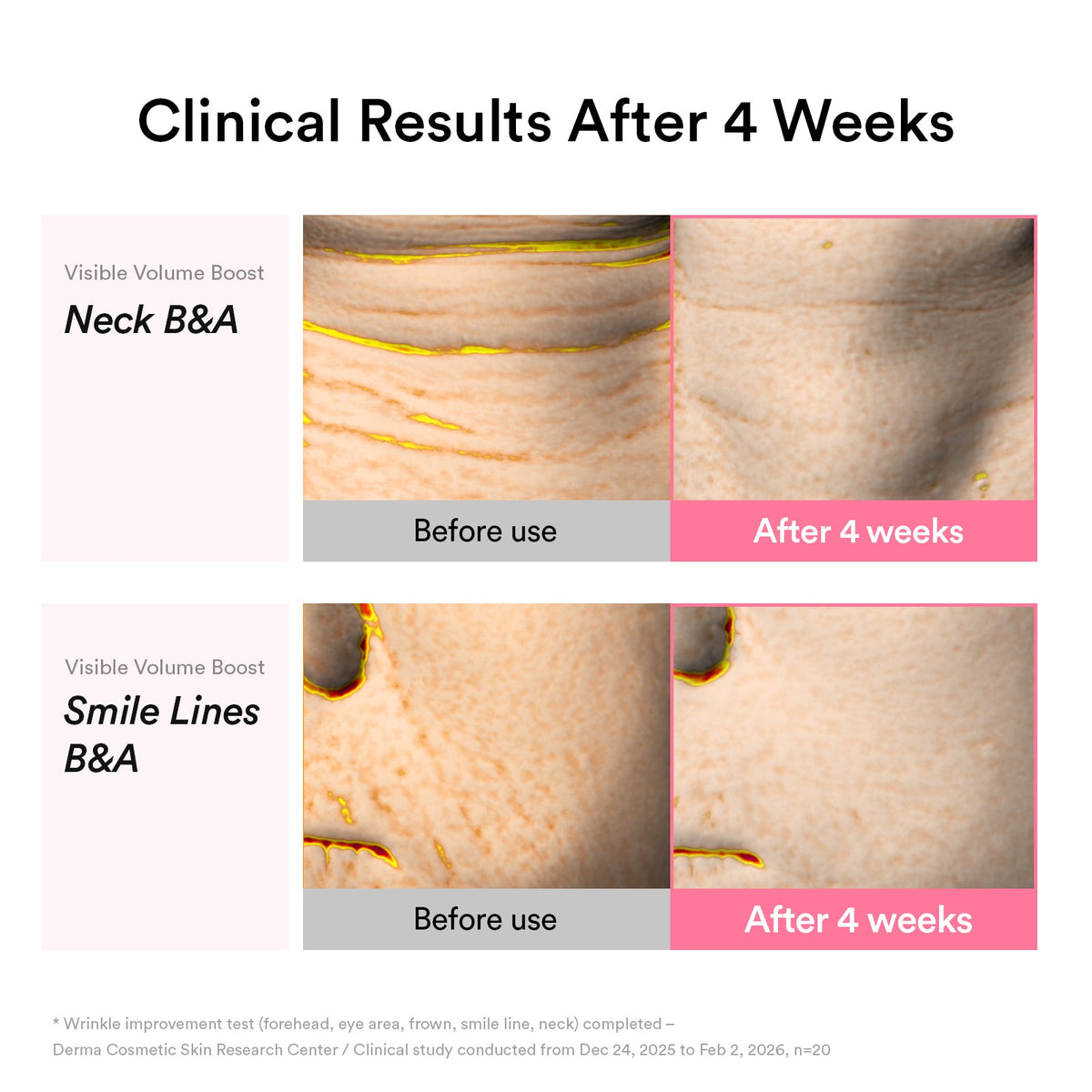 Clinical results after 4 weeks — neck and smile lines before and after